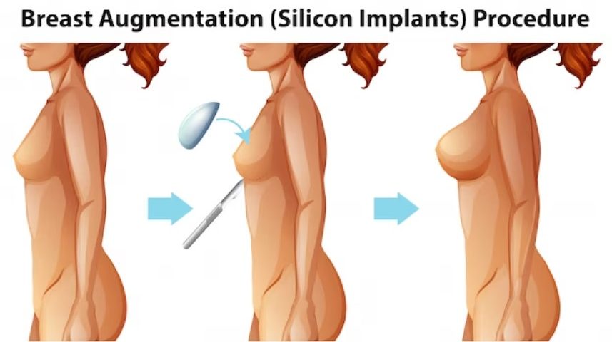 MAMOPLASTIA DE AUMENTO