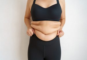 La cirugía de abdominoplastia